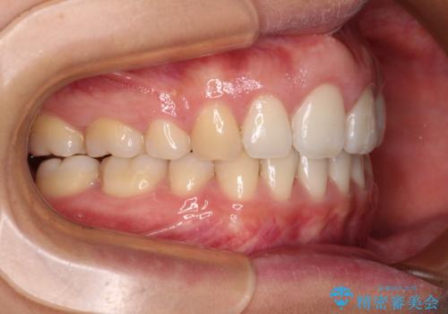 前歯の出っ歯と口の閉じにくさが気になる　目立たないワイヤー装置での抜歯矯正の治療後