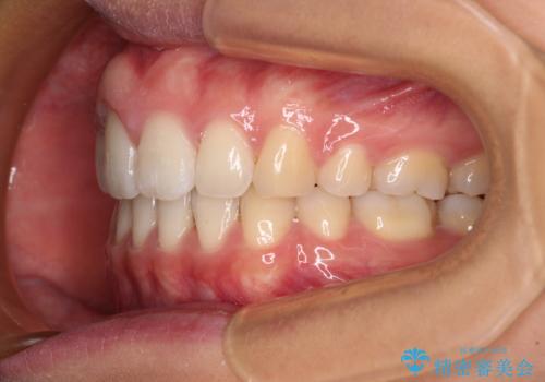 前歯の出っ歯と口の閉じにくさが気になる　目立たないワイヤー装置での抜歯矯正の治療後