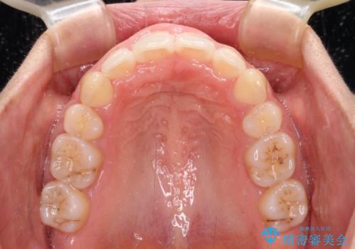 前歯の出っ歯と口の閉じにくさが気になる 目立たないワイヤー装置での抜歯矯正の治療後
