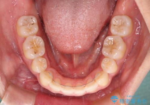 前歯の出っ歯と口の閉じにくさが気になる 目立たないワイヤー装置での抜歯矯正の治療後