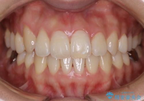 【非抜歯】インビザライン　隠れた前歯を並べる矯正治療の症例 治療後