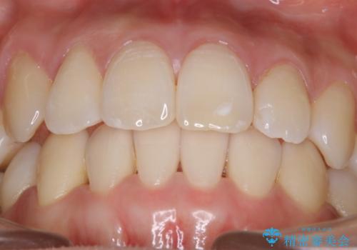 【非抜歯】インビザライン 隠れた前歯を並べる矯正治療の治療後