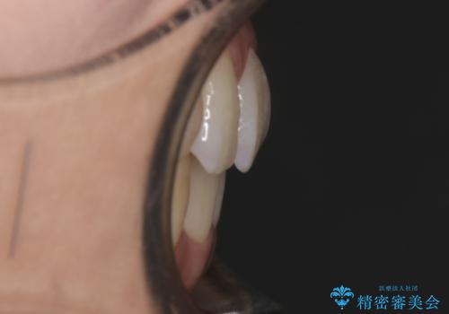 【非抜歯】インビザライン　隠れた前歯を並べる矯正治療の治療後