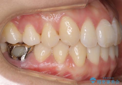 【非抜歯】インビザライン 隠れた前歯を並べる矯正治療の治療後