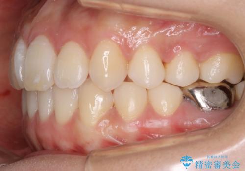 【非抜歯】インビザライン 隠れた前歯を並べる矯正治療の治療後
