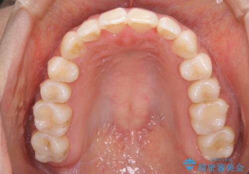 【非抜歯】インビザライン 隠れた前歯を並べる矯正治療の治療後