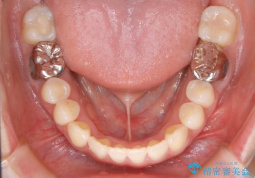 【非抜歯】インビザライン 隠れた前歯を並べる矯正治療の治療後