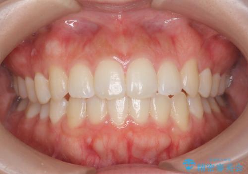 オフィスホワイトニングで1日で歯を白く!!の症例 治療前