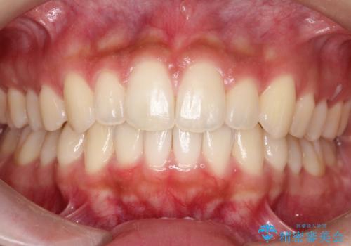 【前歯の見た目をキレイにしたい、引っ込んだ歯も気になる】インビザライン症例の症例 治療後