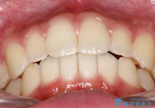 【前歯の見た目をキレイにしたい、引っ込んだ歯も気になる】インビザライン症例の治療後