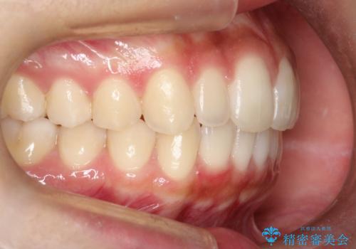 【前歯の見た目をキレイにしたい、引っ込んだ歯も気になる】インビザライン症例の治療後