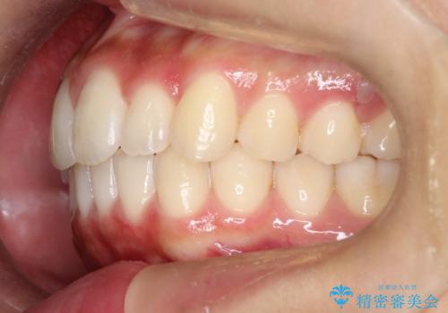 【前歯の見た目をキレイにしたい、引っ込んだ歯も気になる】インビザライン症例の治療後