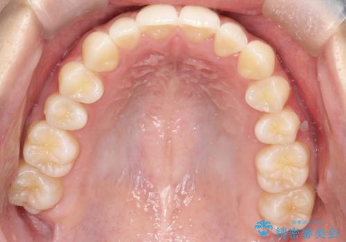 【前歯の見た目をキレイにしたい、引っ込んだ歯も気になる】インビザライン症例の治療後