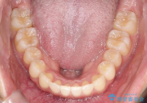 【前歯の見た目をキレイにしたい、引っ込んだ歯も気になる】インビザライン症例の治療後