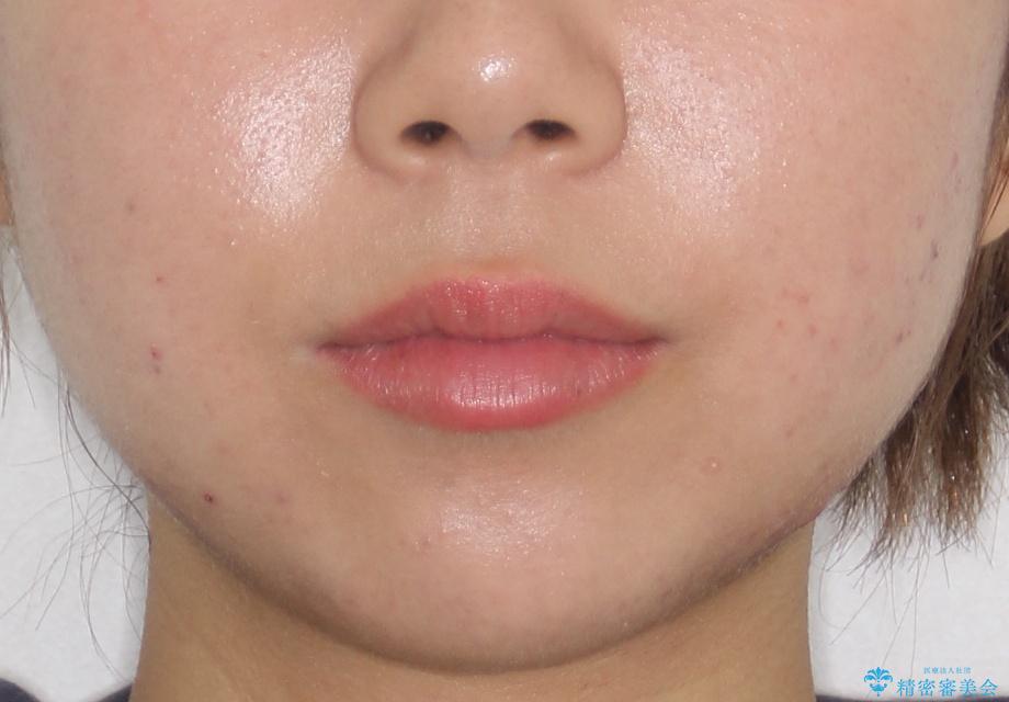 【前歯の見た目をキレイにしたい、引っ込んだ歯も気になる】インビザライン症例の治療後(顔貌)