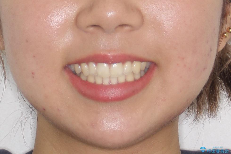 【前歯の見た目をキレイにしたい、引っ込んだ歯も気になる】インビザライン症例の治療後(顔貌)