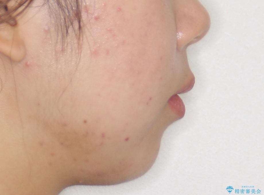 【前歯の見た目をキレイにしたい、引っ込んだ歯も気になる】インビザライン症例の治療後(顔貌)