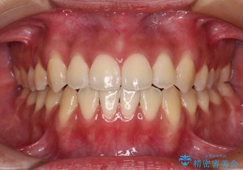 受け口と開咬を急速拡大装置とワイヤー装置で改善の症例 治療後