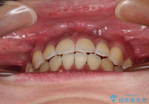 受け口と開咬を急速拡大装置とワイヤー装置で改善の治療後