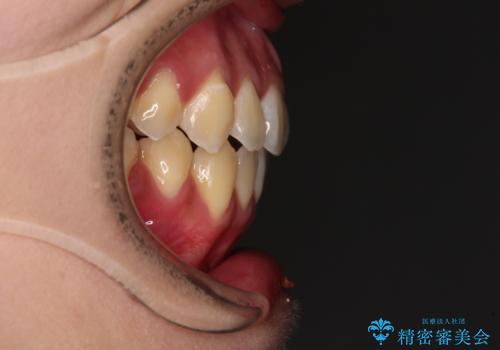 受け口と開咬を急速拡大装置とワイヤー装置で改善の治療後
