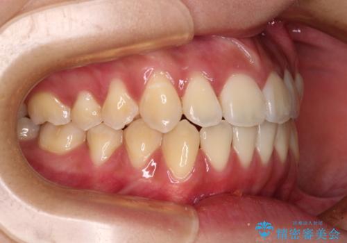 受け口と開咬を急速拡大装置とワイヤー装置で改善の治療後