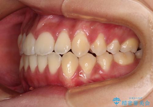 受け口と開咬を急速拡大装置とワイヤー装置で改善の治療後