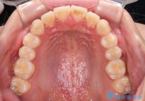 受け口と開咬を急速拡大装置とワイヤー装置で改善の治療後