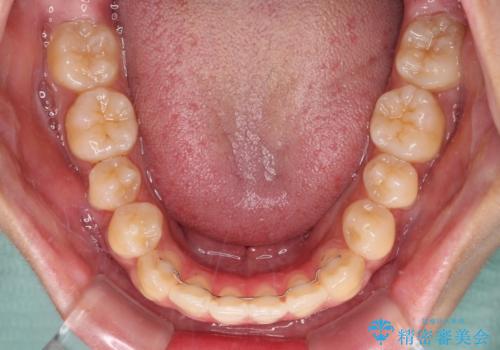 受け口と開咬を急速拡大装置とワイヤー装置で改善の治療後