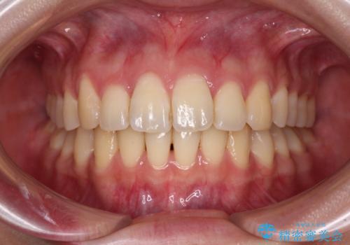 【モニター】飛び出した上顎前歯のワイヤー矯正で改善