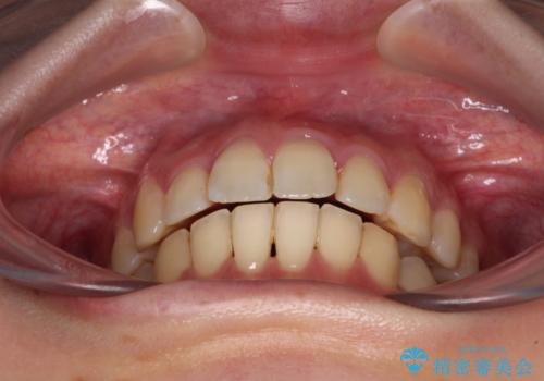 【モニター】飛び出した上顎前歯のワイヤー矯正で改善の治療後