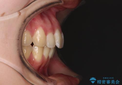 【モニター】飛び出した上顎前歯のワイヤー矯正で改善の治療後