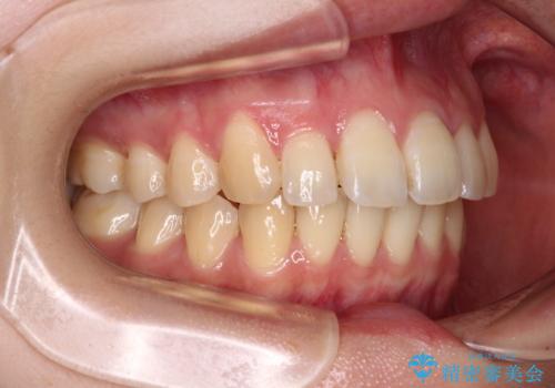 【モニター】飛び出した上顎前歯のワイヤー矯正で改善の治療後