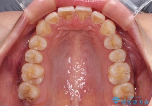 【モニター】飛び出した上顎前歯のワイヤー矯正で改善の治療後