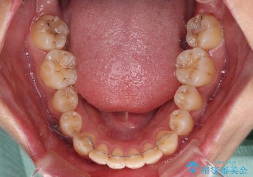 【モニター】飛び出した上顎前歯のワイヤー矯正で改善の治療後