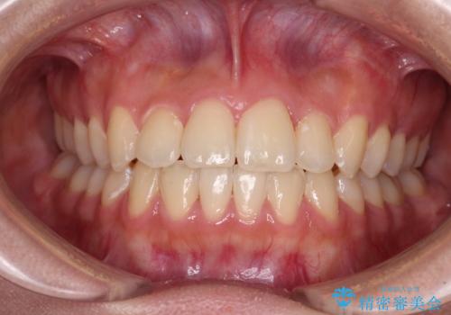 前歯のクロスバイトを短期間で解消　目立たないワイヤー矯正の症例 治療後