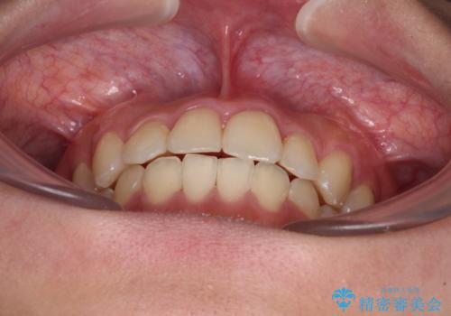 前歯のクロスバイトを短期間で解消 目立たないワイヤー矯正の治療後