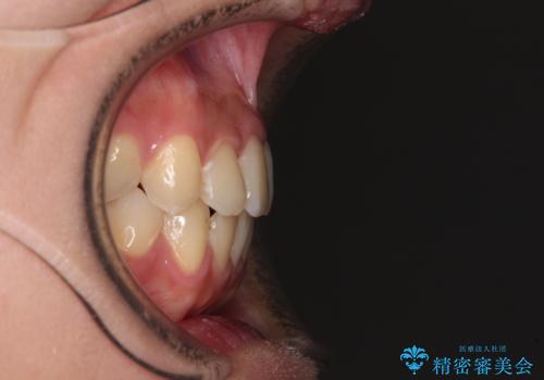 前歯のクロスバイトを短期間で解消　目立たないワイヤー矯正の治療後
