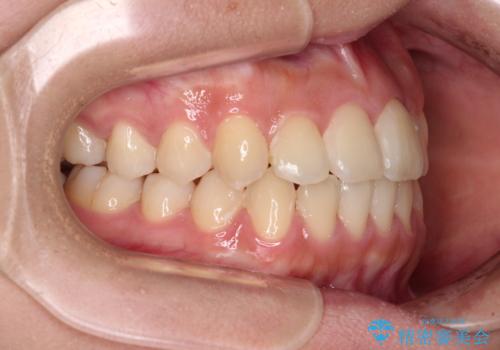 前歯のクロスバイトを短期間で解消 目立たないワイヤー矯正の治療後