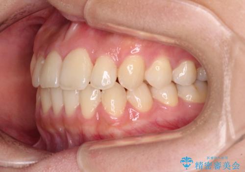 前歯のクロスバイトを短期間で解消　目立たないワイヤー矯正の治療後