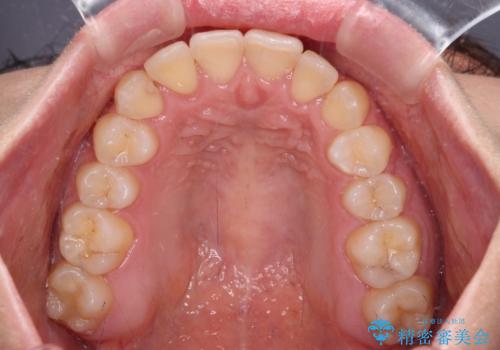 前歯のクロスバイトを短期間で解消 目立たないワイヤー矯正の治療後
