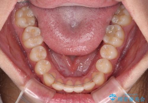 前歯のクロスバイトを短期間で解消 目立たないワイヤー矯正の治療後