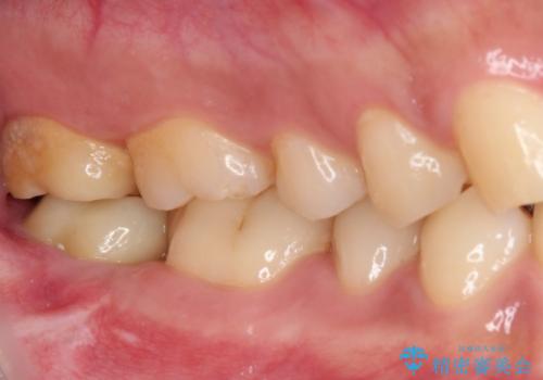 被せものが入れられない 外科処置を行ったセラミック治療の治療後