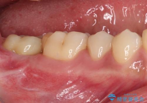 被せものが入れられない 外科処置を行ったセラミック治療の治療後