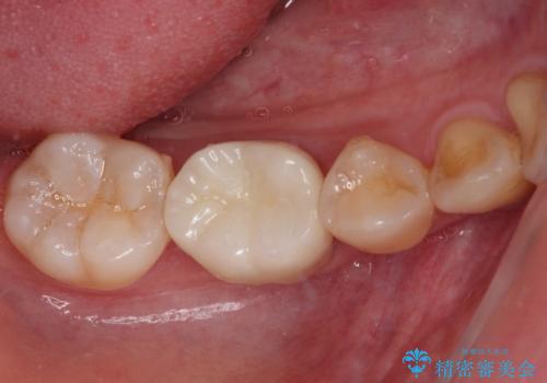歯が欠けてしみる　オールセラミッククラウンによる虫歯治療の症例 治療後