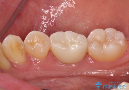歯が欠けてしみる オールセラミッククラウンによる虫歯治療の治療後