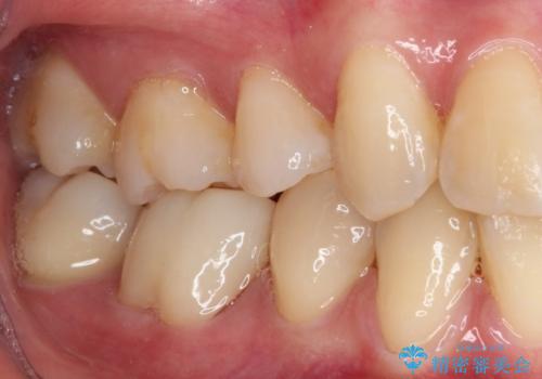 歯が欠けてしみる　オールセラミッククラウンによる虫歯治療の治療後