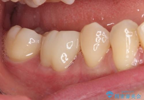 歯が欠けてしみる オールセラミッククラウンによる虫歯治療の治療後