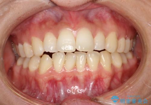 出っ歯で口が閉じずらい ワイヤーによる抜歯矯正の治療前