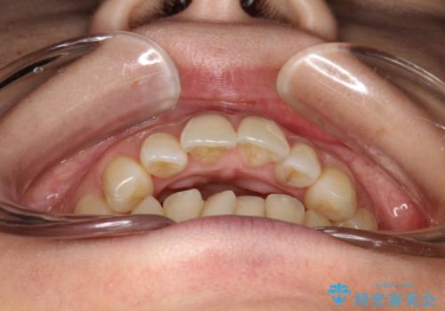 出っ歯で口が閉じずらい ワイヤーによる抜歯矯正の治療前