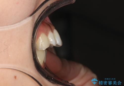出っ歯で口が閉じずらい　ワイヤーによる抜歯矯正の治療前